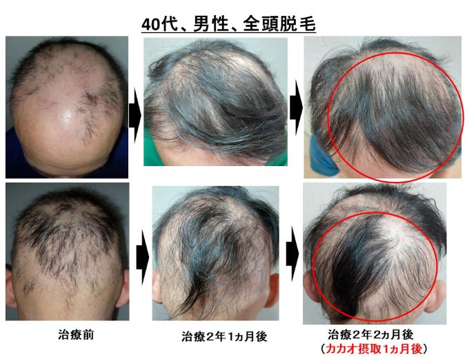 円形脱毛症　病院
